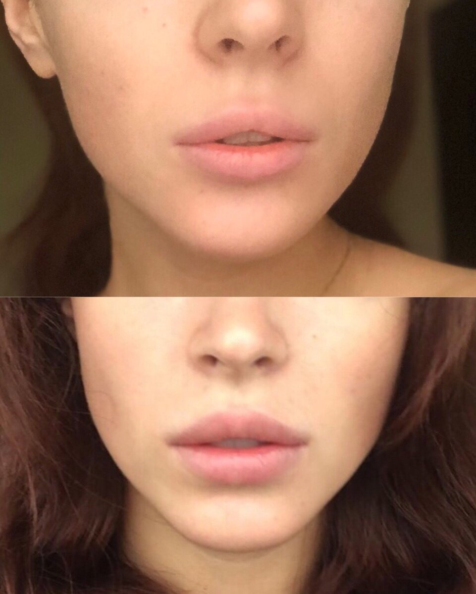 Удаление малых губ до и после фото. Увеличенные губы красивые. Натуральные губы. Красивые накаченные губы до и после.