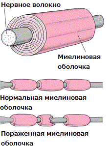 Так что же это такое – РЭМ? Острый рассеянный энцефаломиелит характеризуется выработкой антител в организме человека, которые начинают уничтожать миелиновую оболочку головного и спинного мозга. В результате такой атаки, все пораженные участки прекращают свое нормальное функционирование. Данный недуг является не просто опасным, а смертельно опасным и требует пристального внимания.