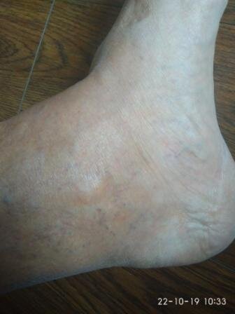 Типичное начало заболевания.