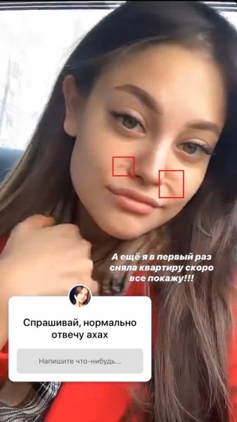 Дилара до и после пластики