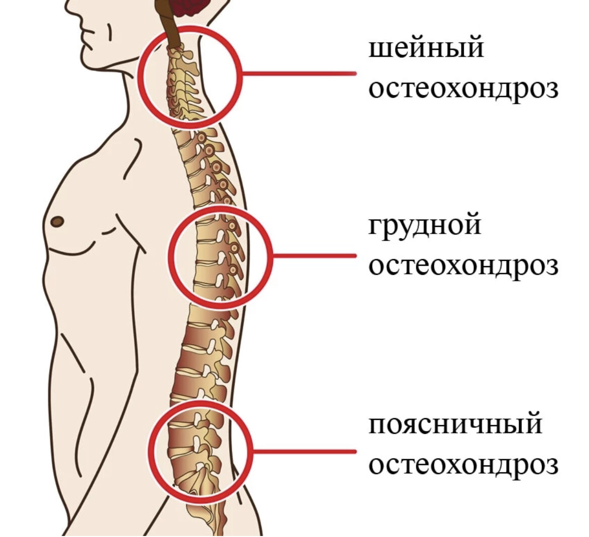 покалывание в груди из за остеохондроза фото 83