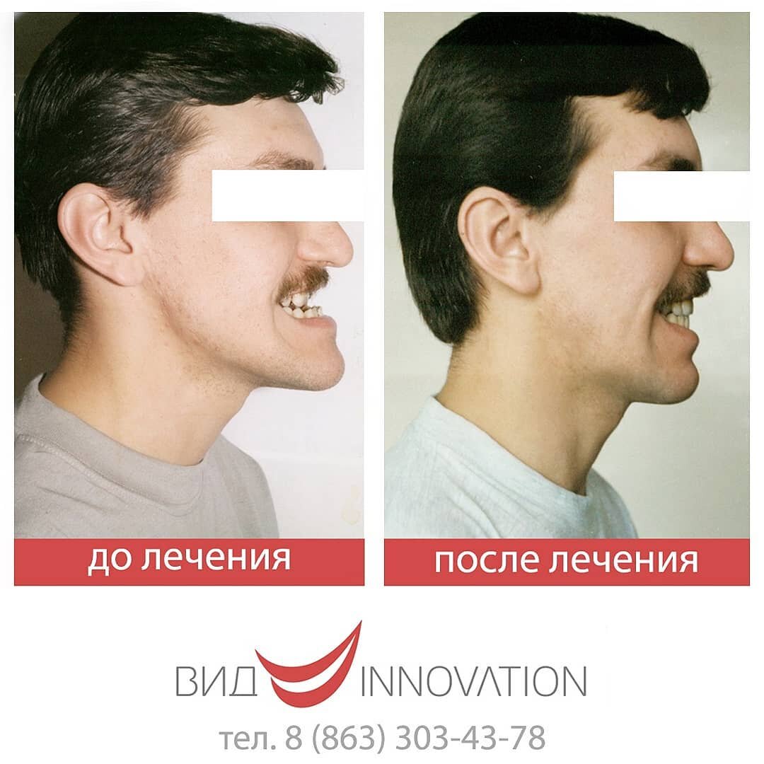Фотографии ХИРУРГИЧЕСКОЕ ИСПРАВЛЕНИЕ ПРИКУСА