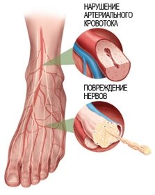Главная причина синдрома диабетической стопы - повреждение нервов и изменения сосудов ног. 