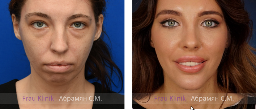 Имиджевая пластика: фото ДО и ПОСЛЕ операции