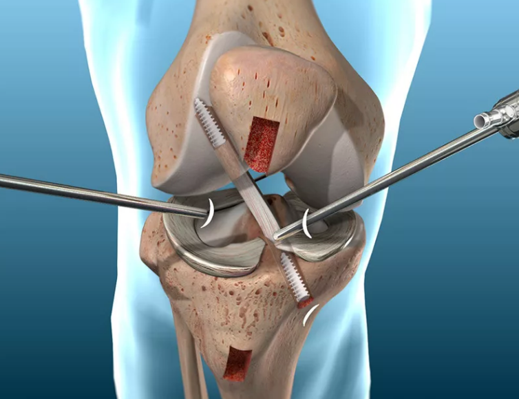 Проведение реконструкции передней крестообразной связки коленного сустава сопровождается длительным реабилитационным периодом