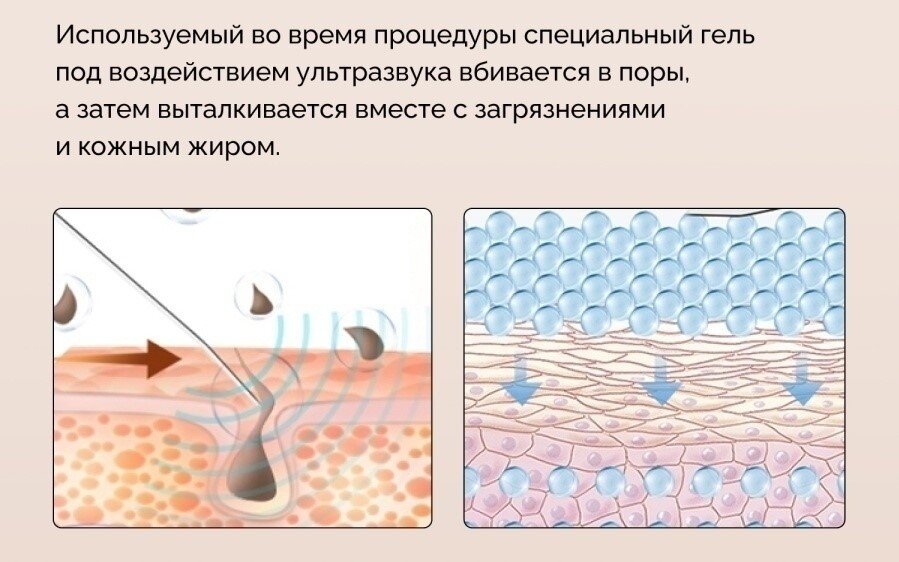 Вот что происходит с кожей в процессе УЗ чистки