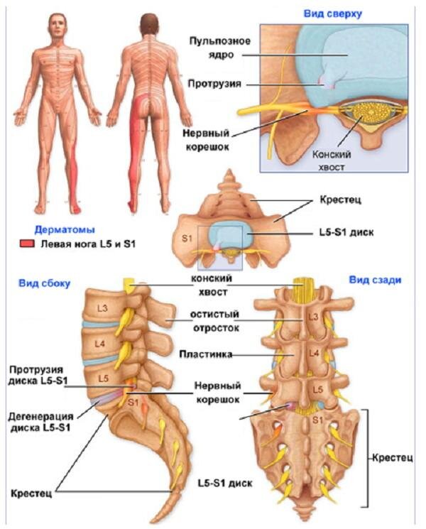 Протрузия крестцового отдела позвоночника лечение. Протрузия дисков поясничного отдела l5-s1. Протрузии l4 l5 l5 s1 пояснично-крестцового отдела. Протрузия дисков позвоночника l4-5. Диски l5-s1 в позвоночнике.