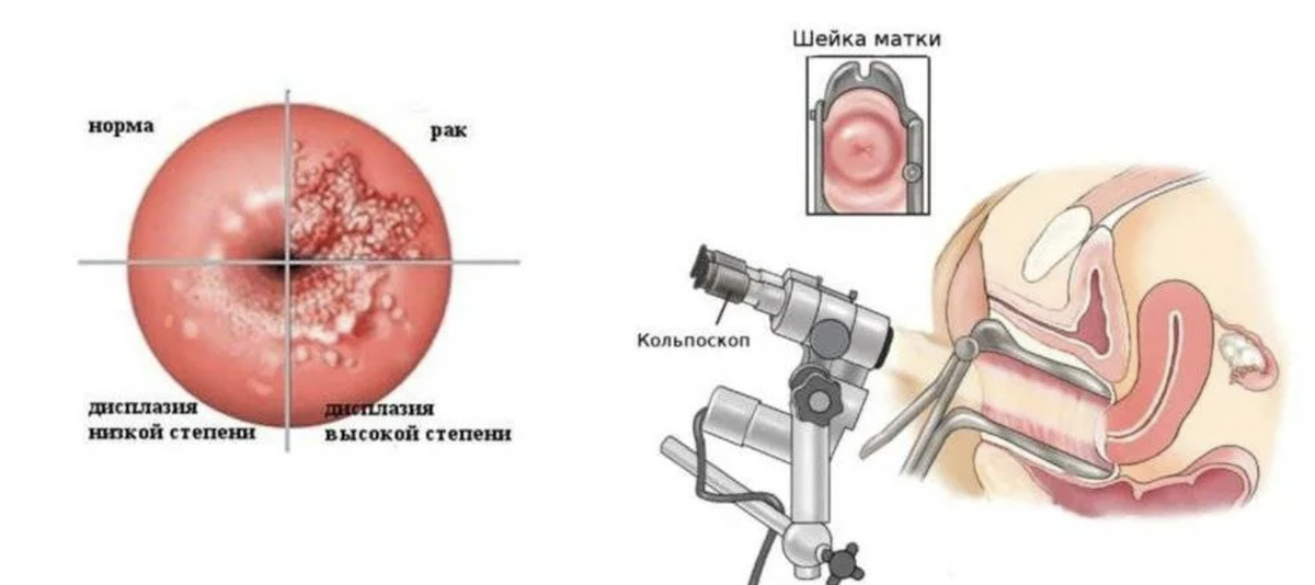 Кольпоскопия – обследование и анализы