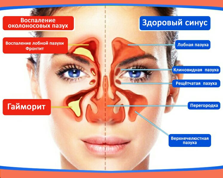 На изображении видно, что воспаление или наличие лишней слизи в одной из пазух является маркером заболевания.