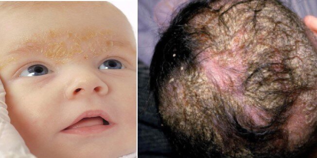 Слева вариант СД на лице, справа - на волосистой части головы