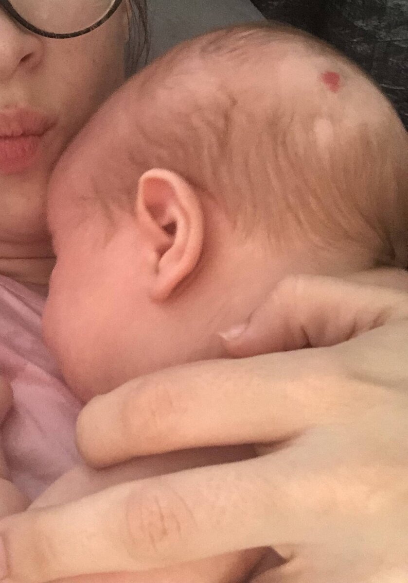 Гемангиома, 3 месяца