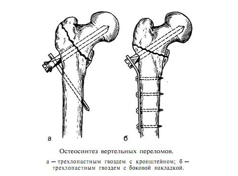 Через бедренный перелом. Вертельный перелом шейки бедра. Чрезвертельный перелом остеосинтез. Остеосинтез перелома бедренной кости. Вертельный перелом бедра операция.