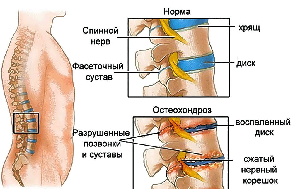 Остеохондроз позвоночника | карусель-нн.рф