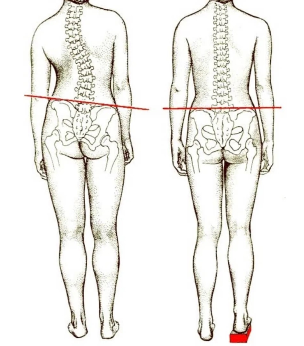 Одна нога короче другой. Искривление позвоночника и таза. Искривление позвоночника сколиоз. Искривление позвоночника перекос таза. Сколиоз костей таза.