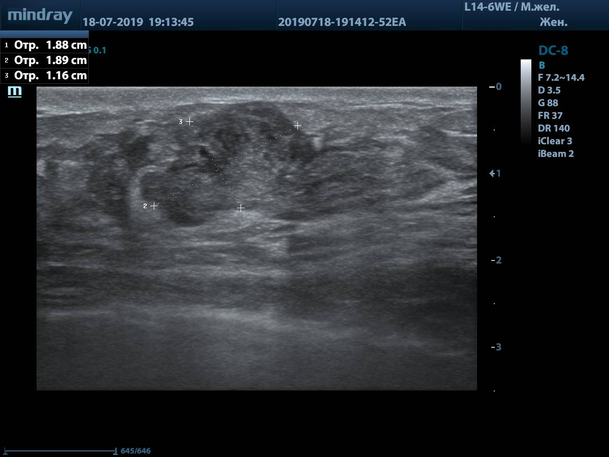 фиброаденома в груди во время беременности фото 117
