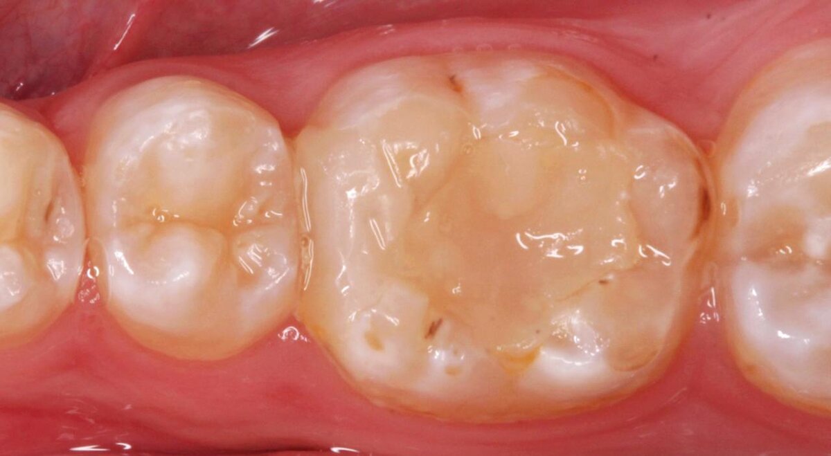 Пример старой большой просевшей пломбы 