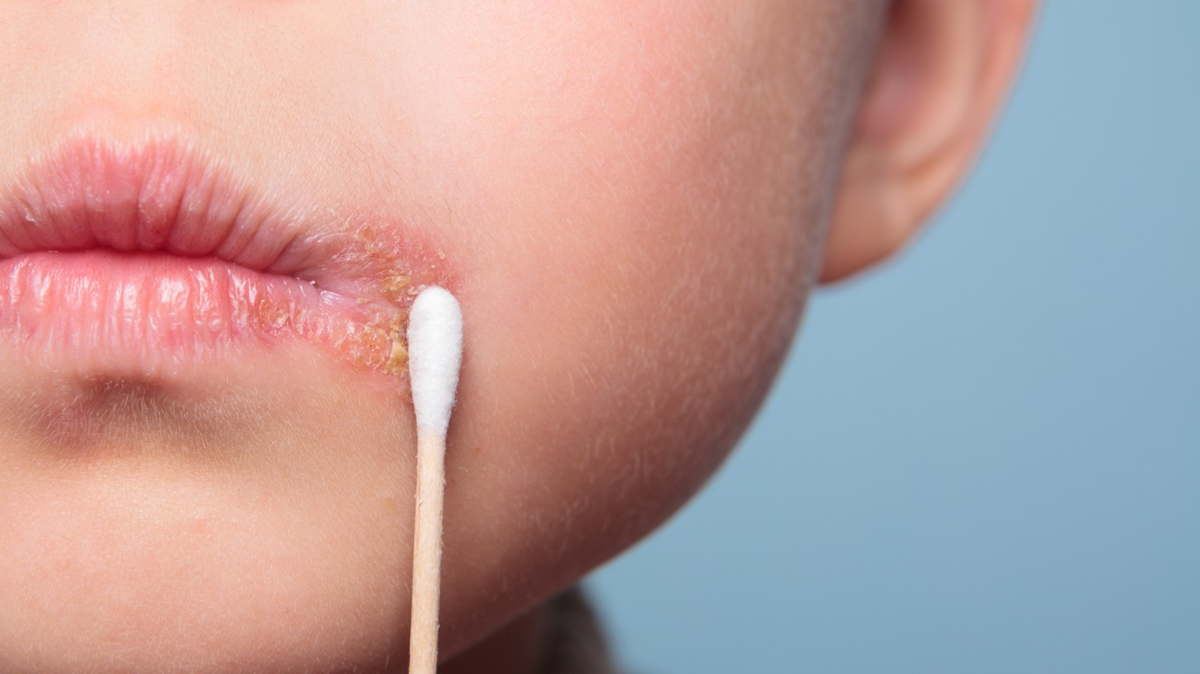 Сухость слизистой носа: причины и лечение