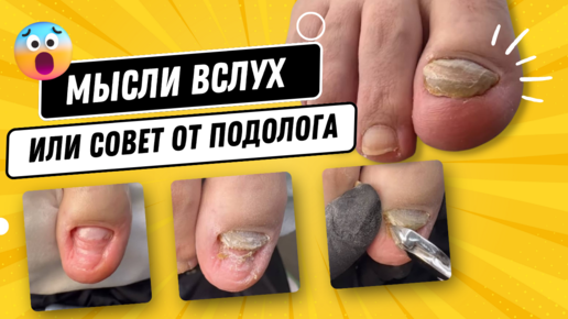 Мысли вслух или совет от подолога / подолог / совет #пациент #подолог # ...