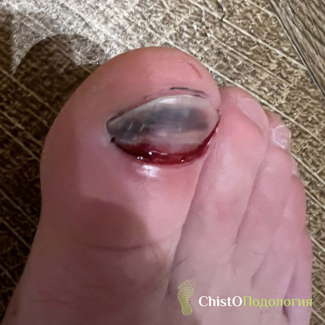 Травма ногтя пациента