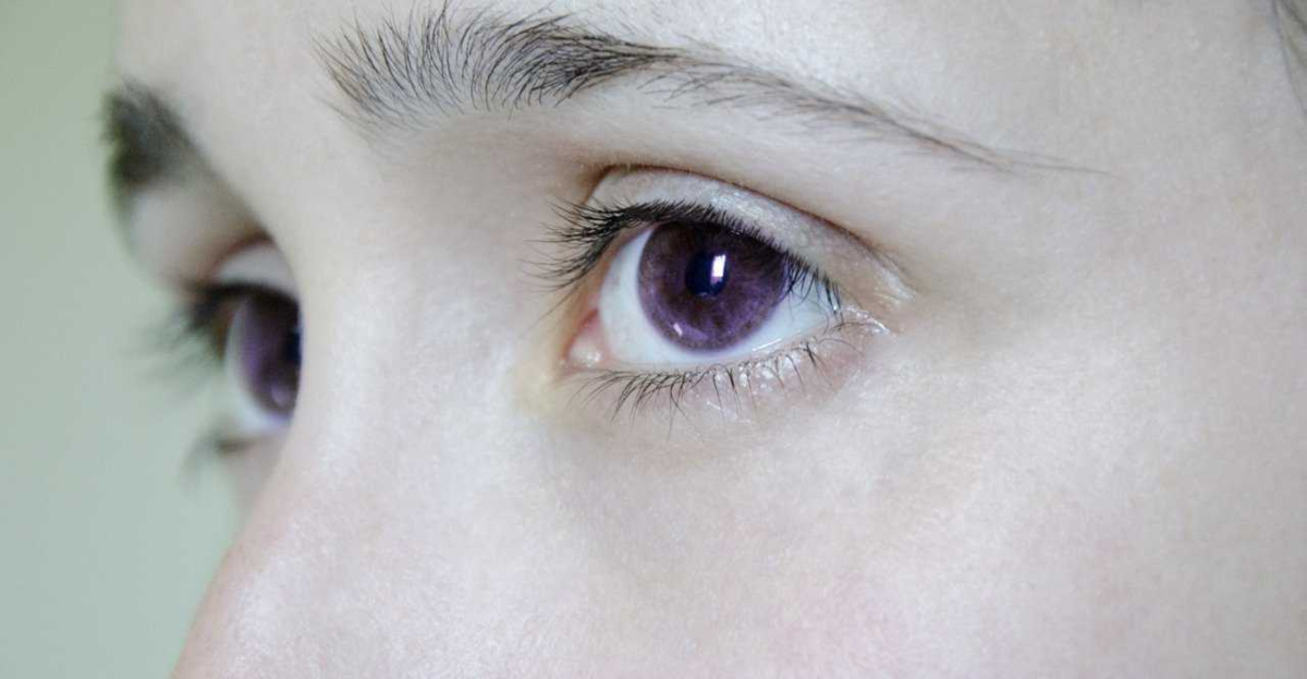 Генезис глазная. Синдром Александрии. Синдром Вейля Маркезани. Генезис Александрии глаза.