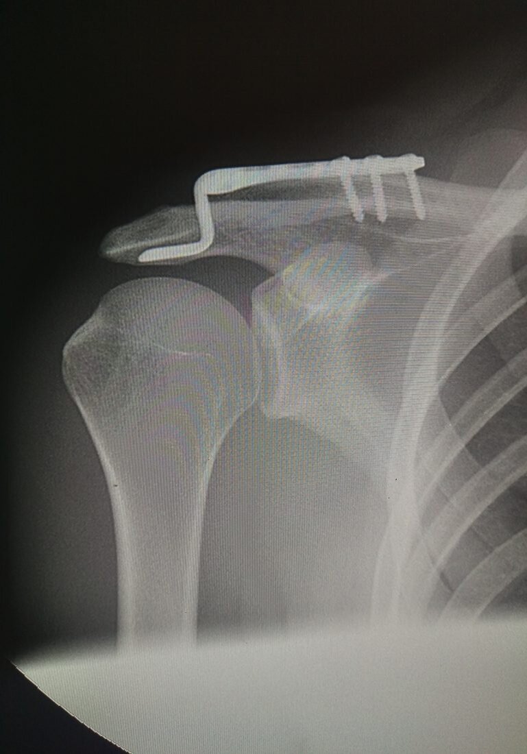 разрыву акромиально-ключичного сочленения ( тип 1). акс 2 степени плечевого сустава. повреждение ключично акромиального сочленения. подвывих акс рентген. повреждение ключично акромиального сочленения.