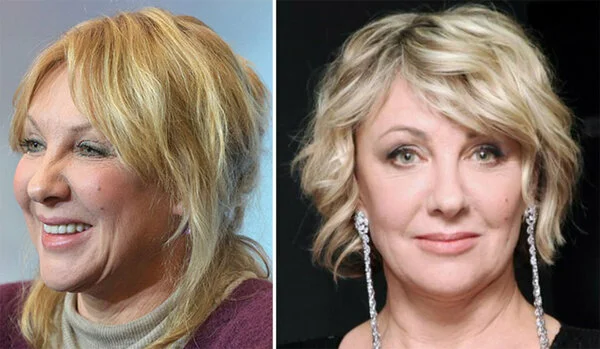 Елена яковлева актриса пластика лица фото до и после