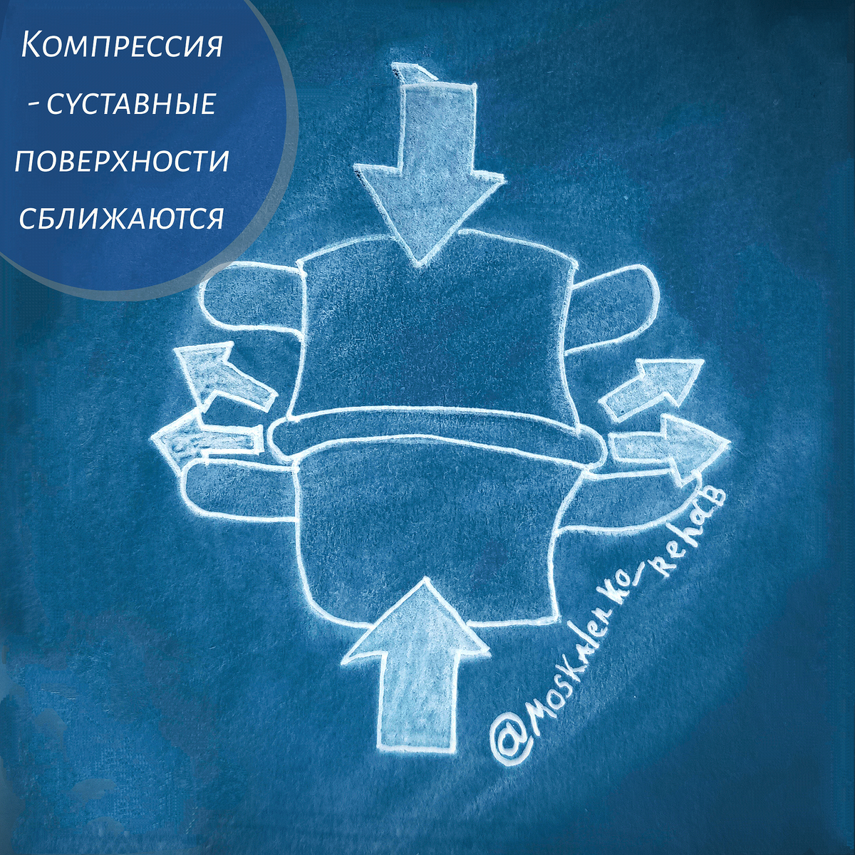 Схематичное изображение компрессии ПДС. При тракции позвонки будут отдаляться друг от друга