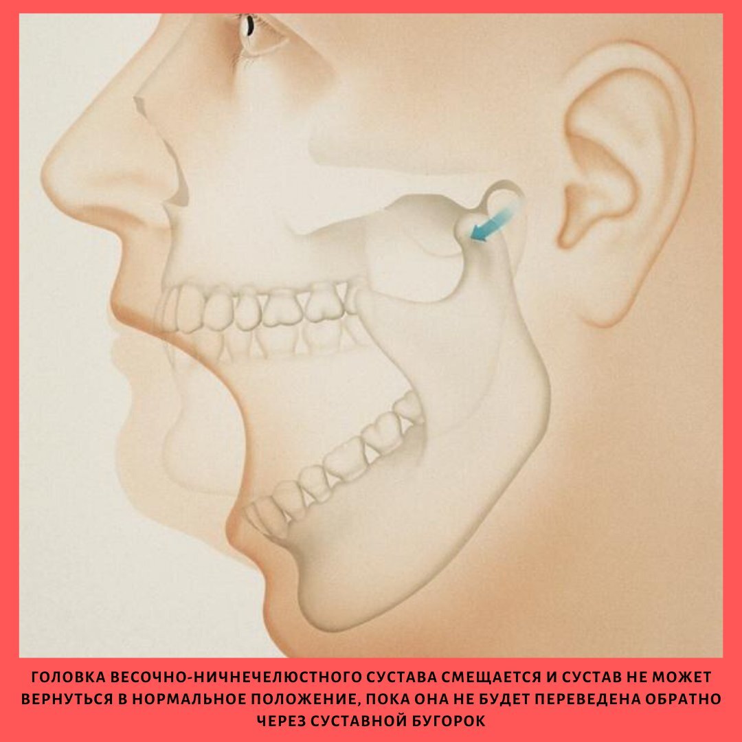 Вывих челюсти | Онлайн-школа первой помощи №1 | Дзен