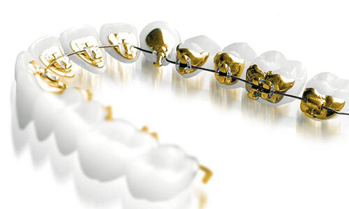 Так выглядят лингвальные брекет-системы