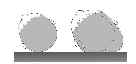 Рисунок 1. Деформационная плагиоцефалия.
Gary F. Rogers, MD, JD, MBA, MPH. Deformational Plagiocephaly, Brachycephaly, and Scaphocephaly. Part I: Terminology, Diagnosis, and Etiopathogenesis