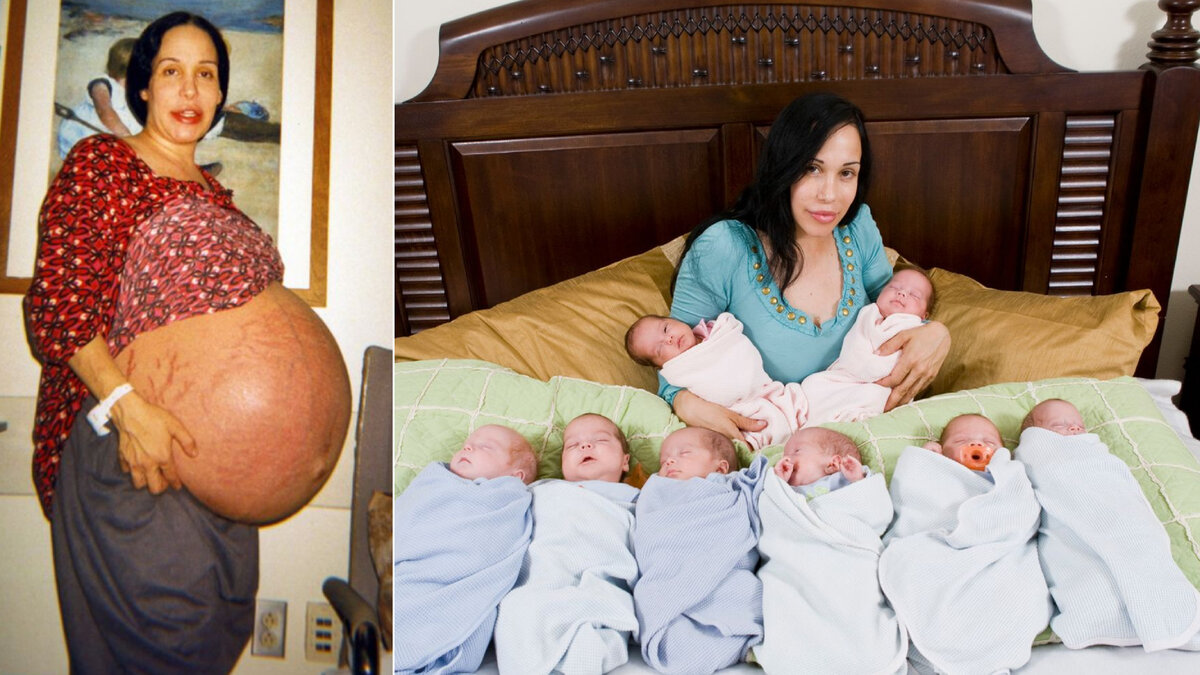 Случаи беременности после. Октомама. Suleman octuplets.