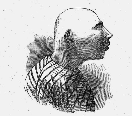 Иллюстрация из книги Д-ра Айрлэнда Идiотизм и тупоумiе Петербург 1880 г.