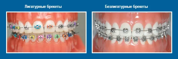 Индивидуальный проект брекет системы