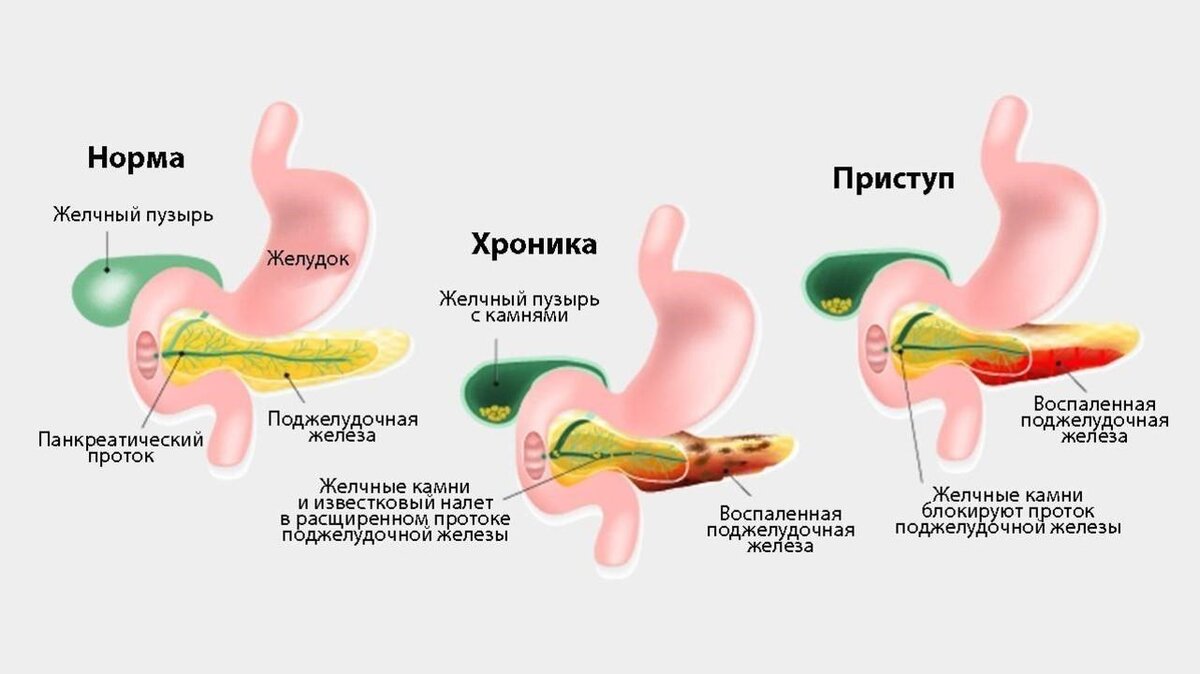 Панкреатит: как снять приступ?