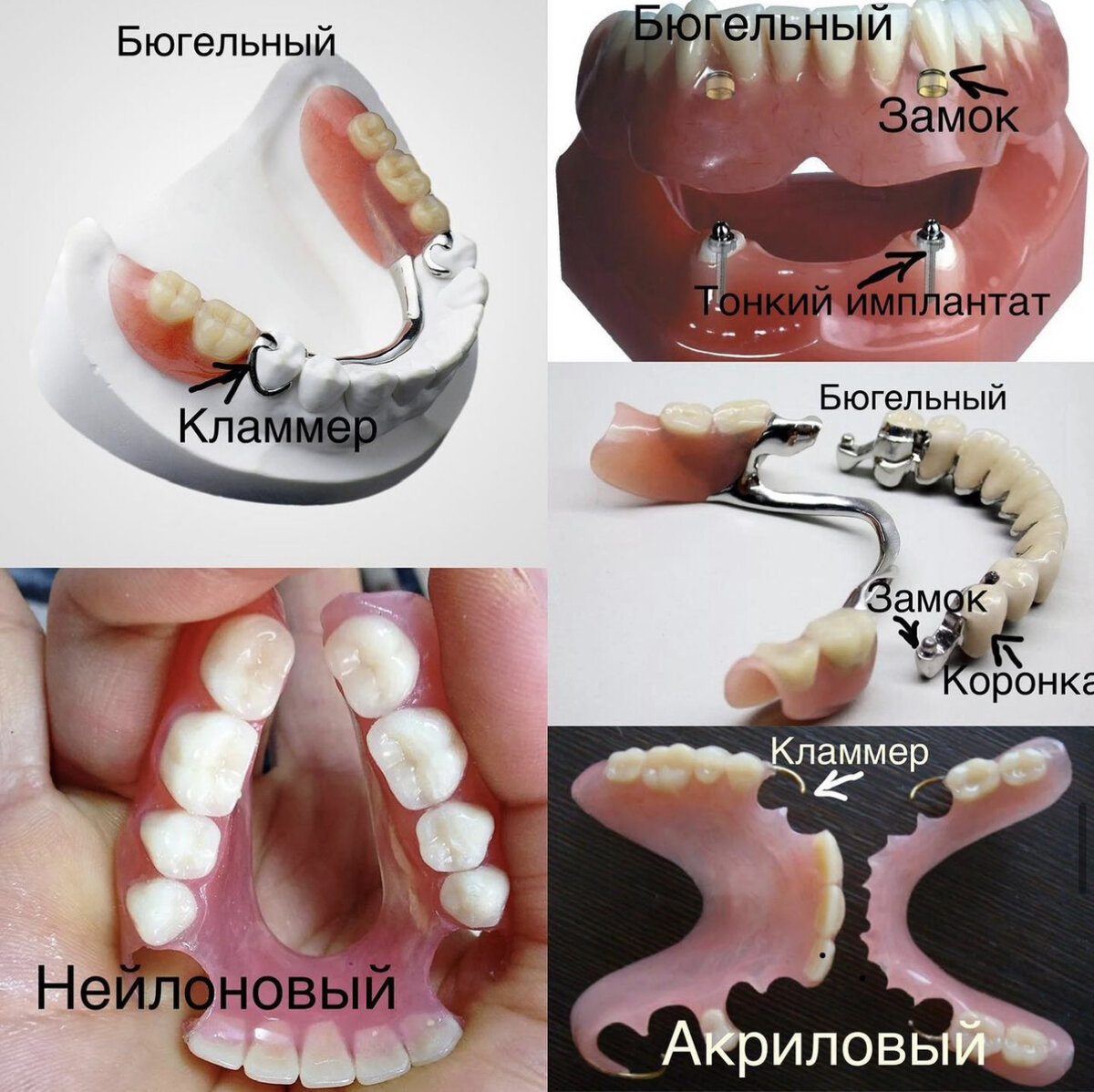 виды протезирования зубов фото цены