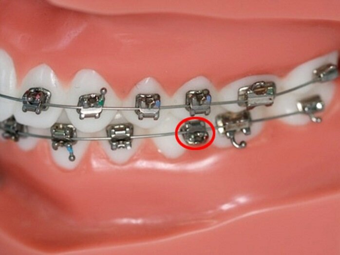 Отклейка самолигирующегося брекета