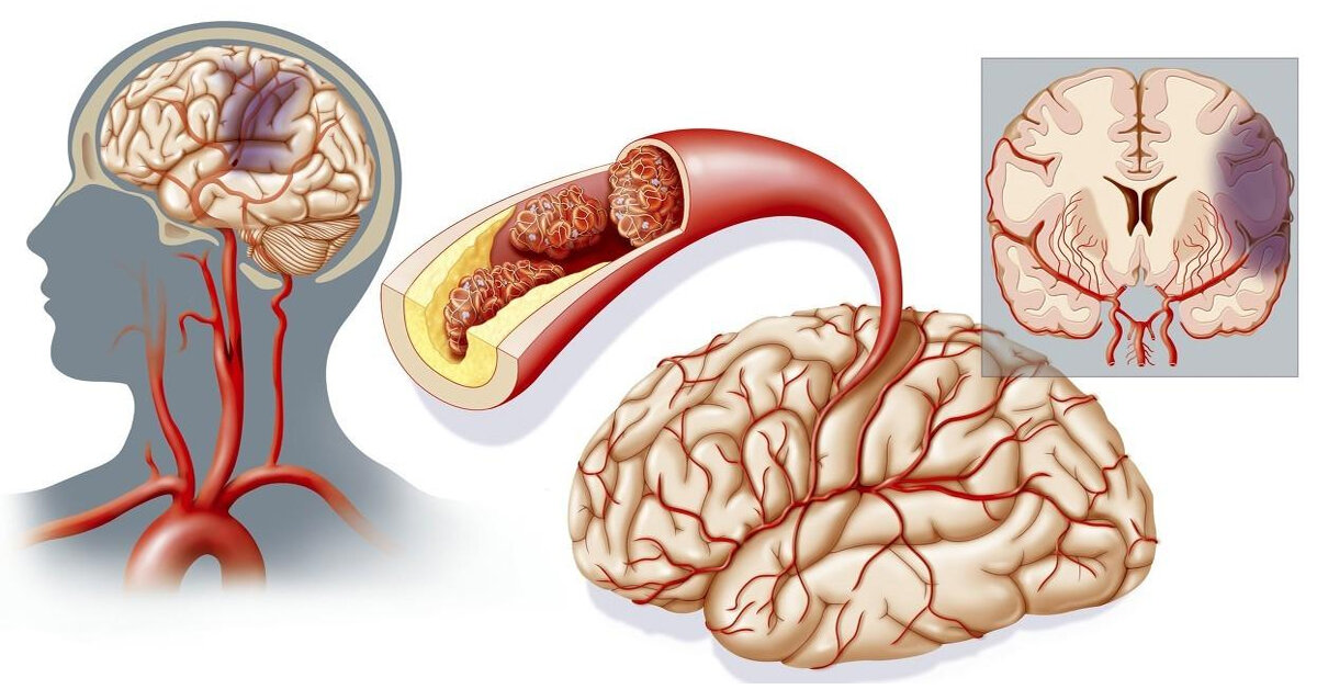 Атеросклероз мозга симптомы. Ишемический микроинсульт. ОНМК ишемический инсульт. ОНМК геморрагический инсульт. Инсульт ишемический (закупорка сосуда).