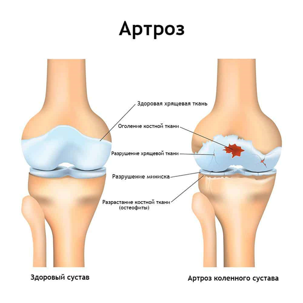 Лечение артроза тазобедренного сустава блог компании | Новый шаг