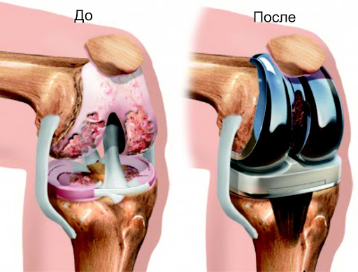 Лечение артрита коленного сустава