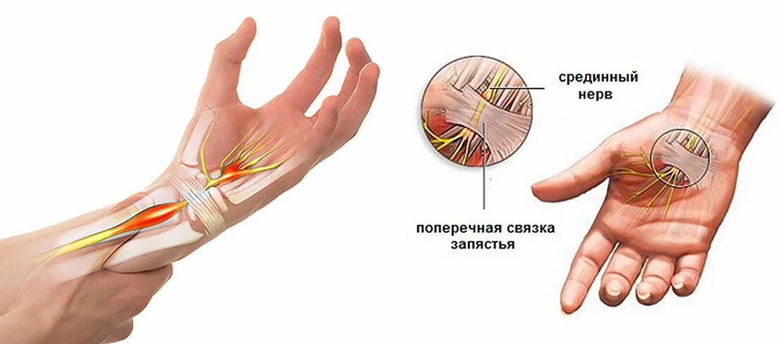 Синдром запястного канала картинки