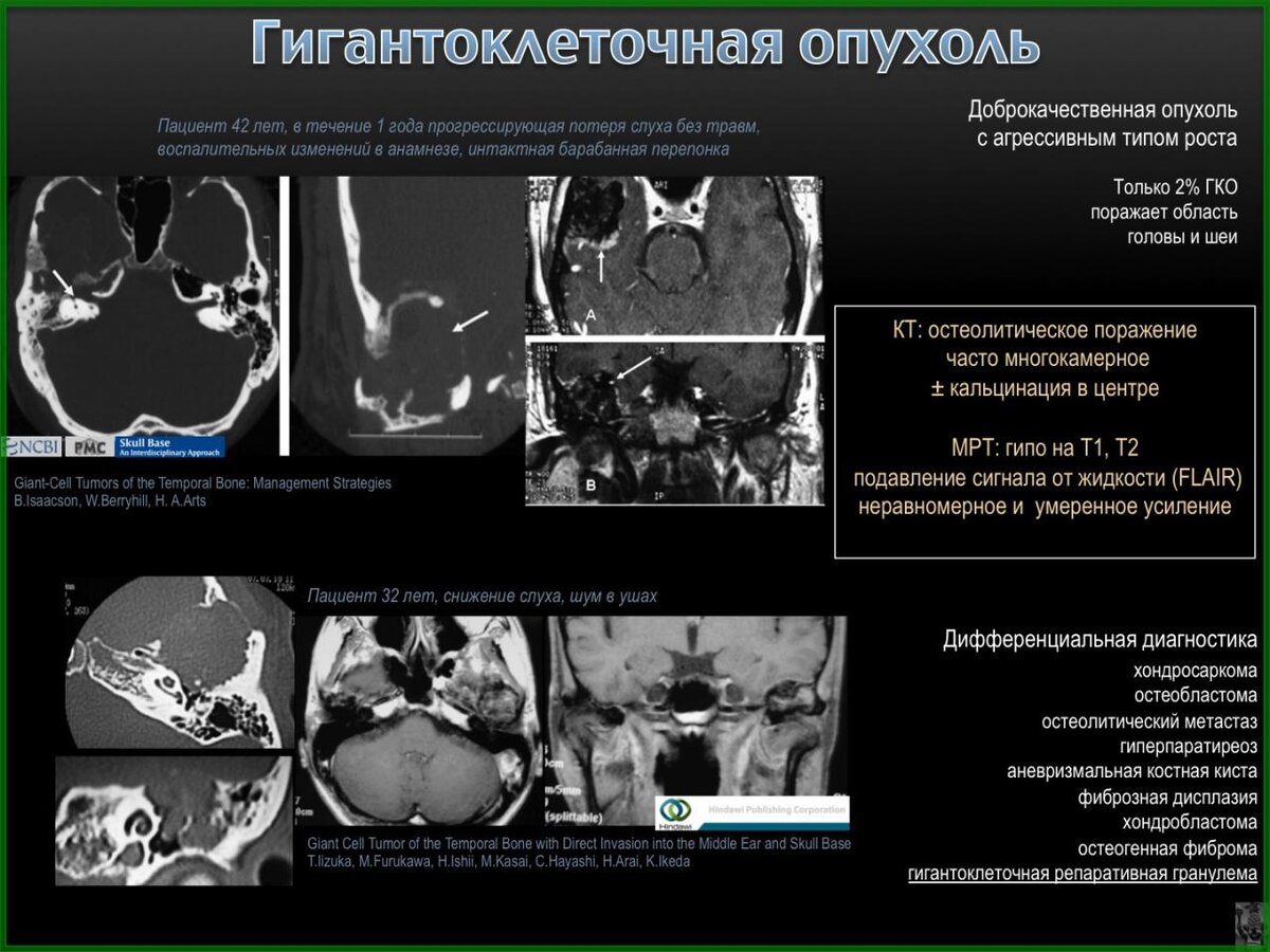 Опухоли внутреннего уха. Гигантоклеточная опухоль кт. Опухоли позвоночника кт.