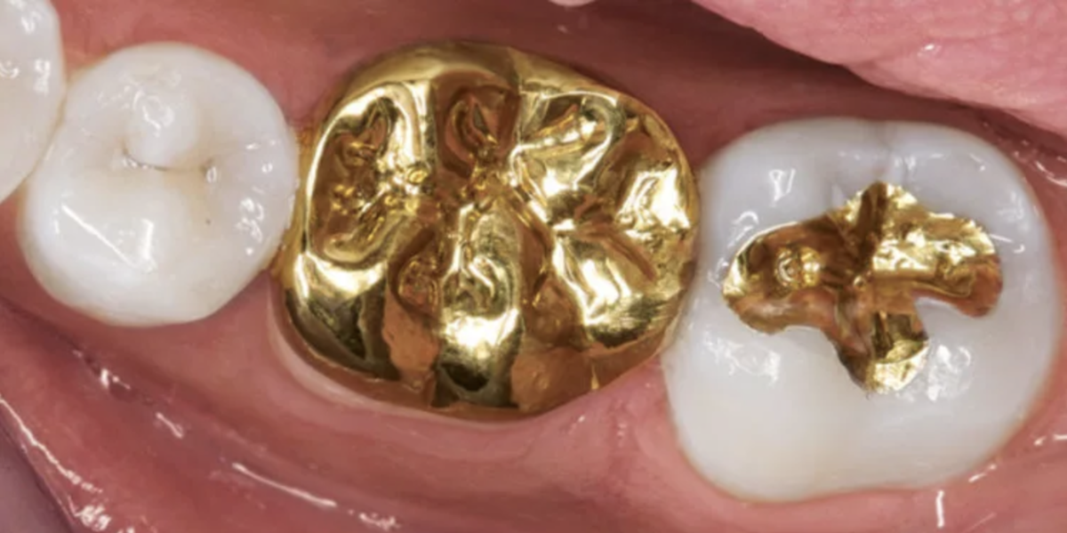 Штампованные коронки на зубы. Коронка цельнолитая (сплав remanium). Золото в стоматологии. Золотые зубные коронки.