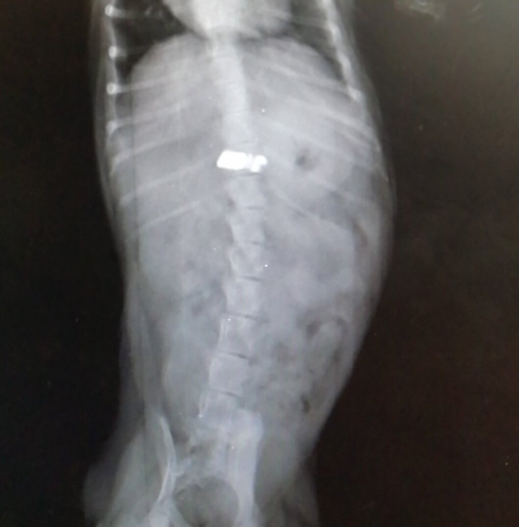 Инородный регнтгенконтрастный предмет в области желудка