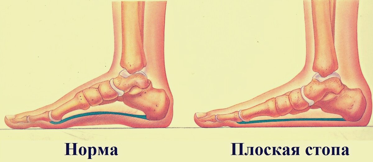 Обувь с плоской подошвой имеет последствия