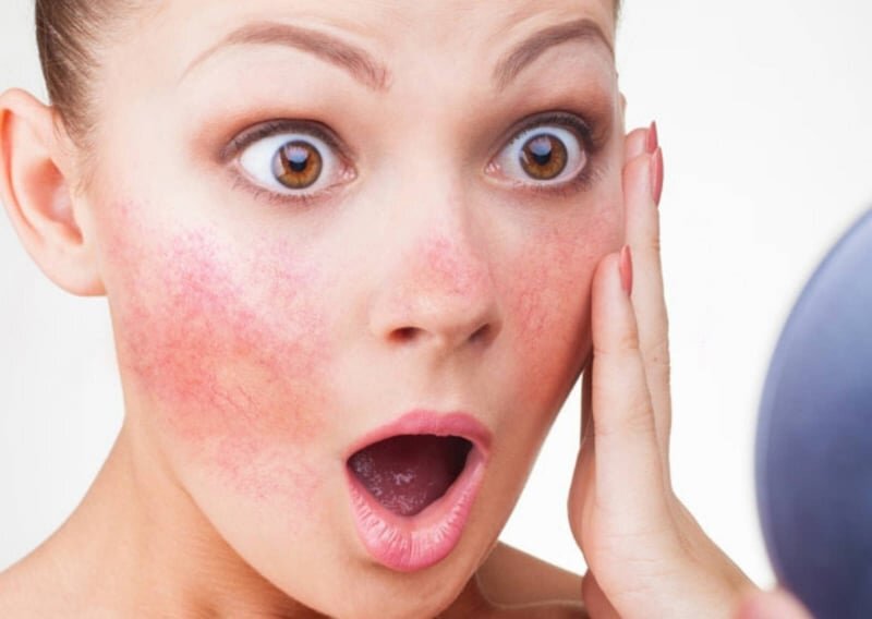 Купероз проявляется покраснениями на коже лица, вследствие слабости сосудов, что приводит к лопнувшим капиллярам. Обычно купероз проявляется на щеках, крыльях носа и подбородке.