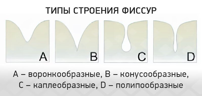 Первые два типа фиссур – «открытые», их лучше омывает слюной, проще чистить зубной щеткой, там меньше скапливается зубной налет. Фото: Яндекс.Картинки.