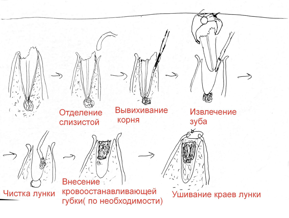 Ретинированный и дистопированный зуб | Стоматология Митино