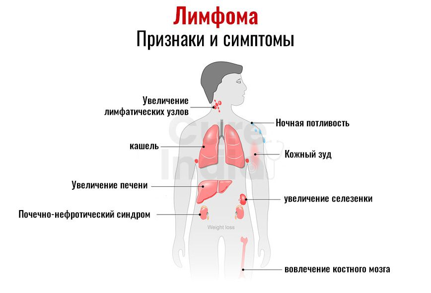 Лимфома симптомы у взрослых фото