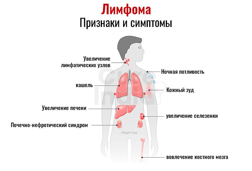 Лечится ли лимфома