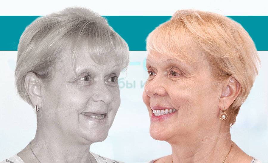 Протезы на имплантах – это удобно, физиологично и невероятно красиво! На фото – реальная пациентка Smile-at-Once.ru. 